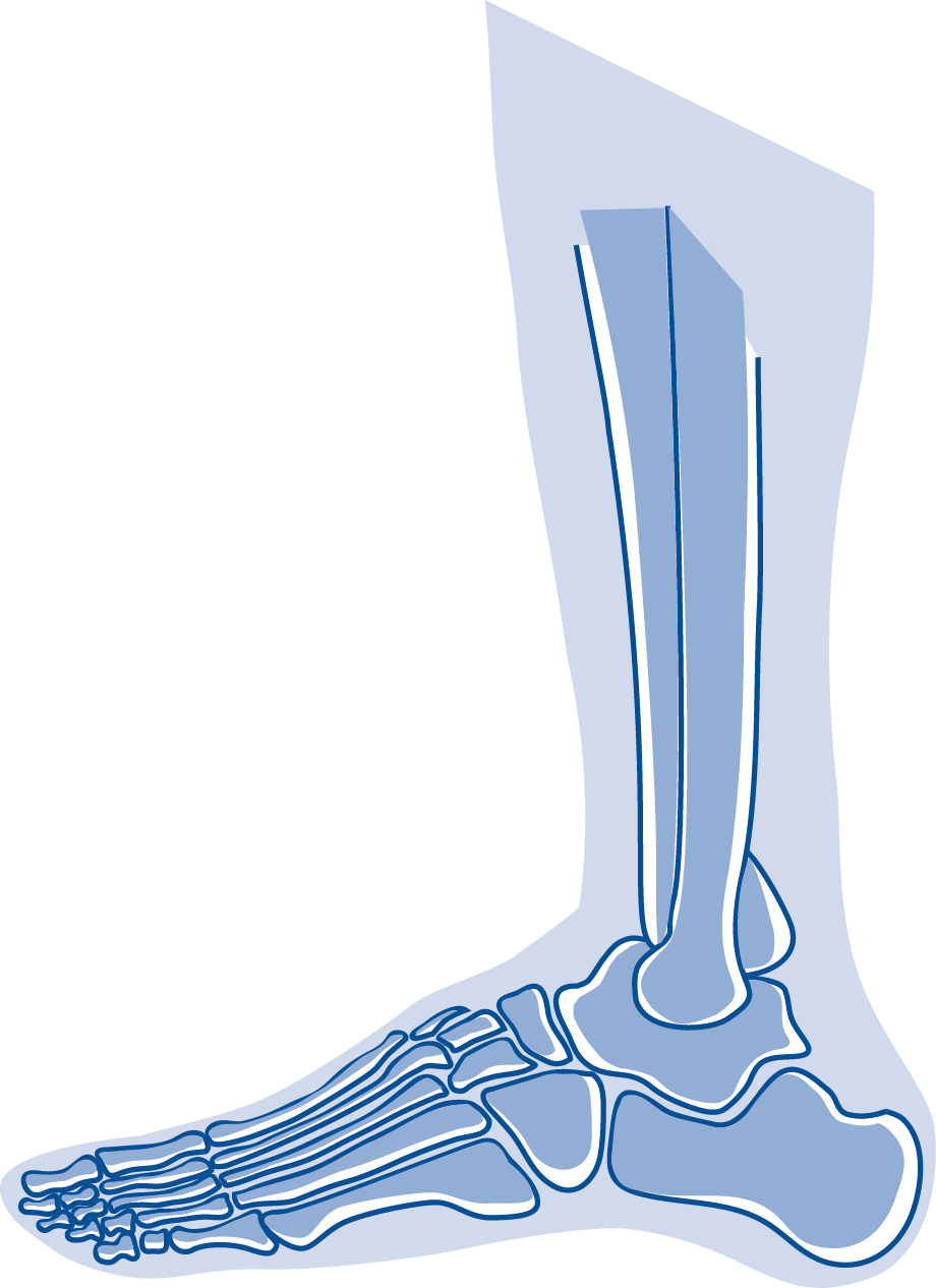 Informationsabend der Orthopädie: Fußchirurgie