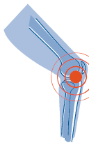 Informationsabend der Orthopädie: Die schmerzhafte Knieprothese