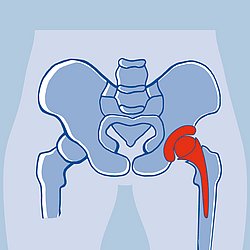 Eine Zeichnung einer Hüfte auf blauem Grund mit roter Hüftprothese