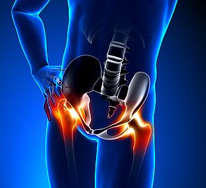 Informationsabend der Orthopädie: Rund um die Hüfte